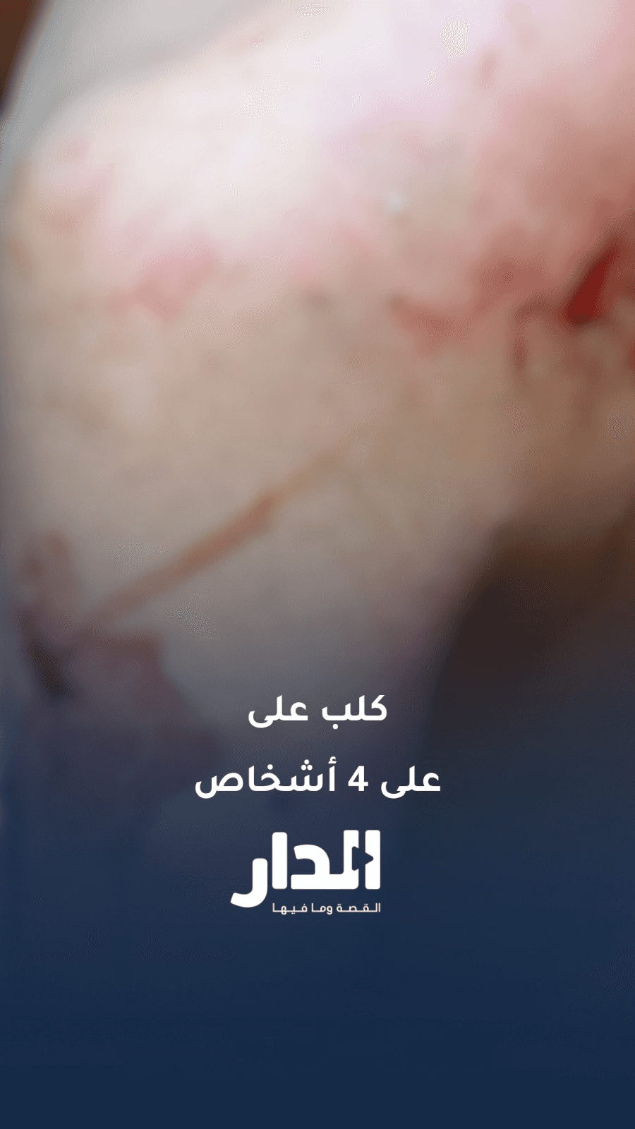 كلب يهاجم عددًا من الأشخاص بينهم طفلة ومسنة في زيزيا