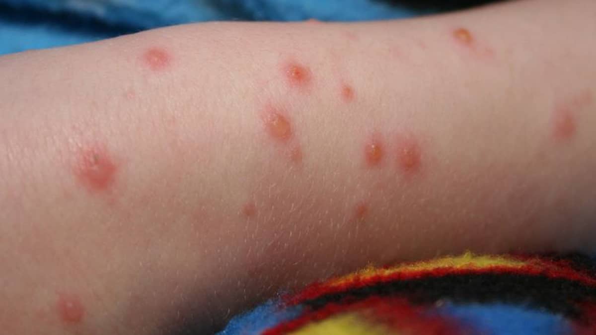 طبيب أمراض معدية يحذر من مضاعفات "جدري الماء" لدى البالغين وتأثير كورونا على المناعة