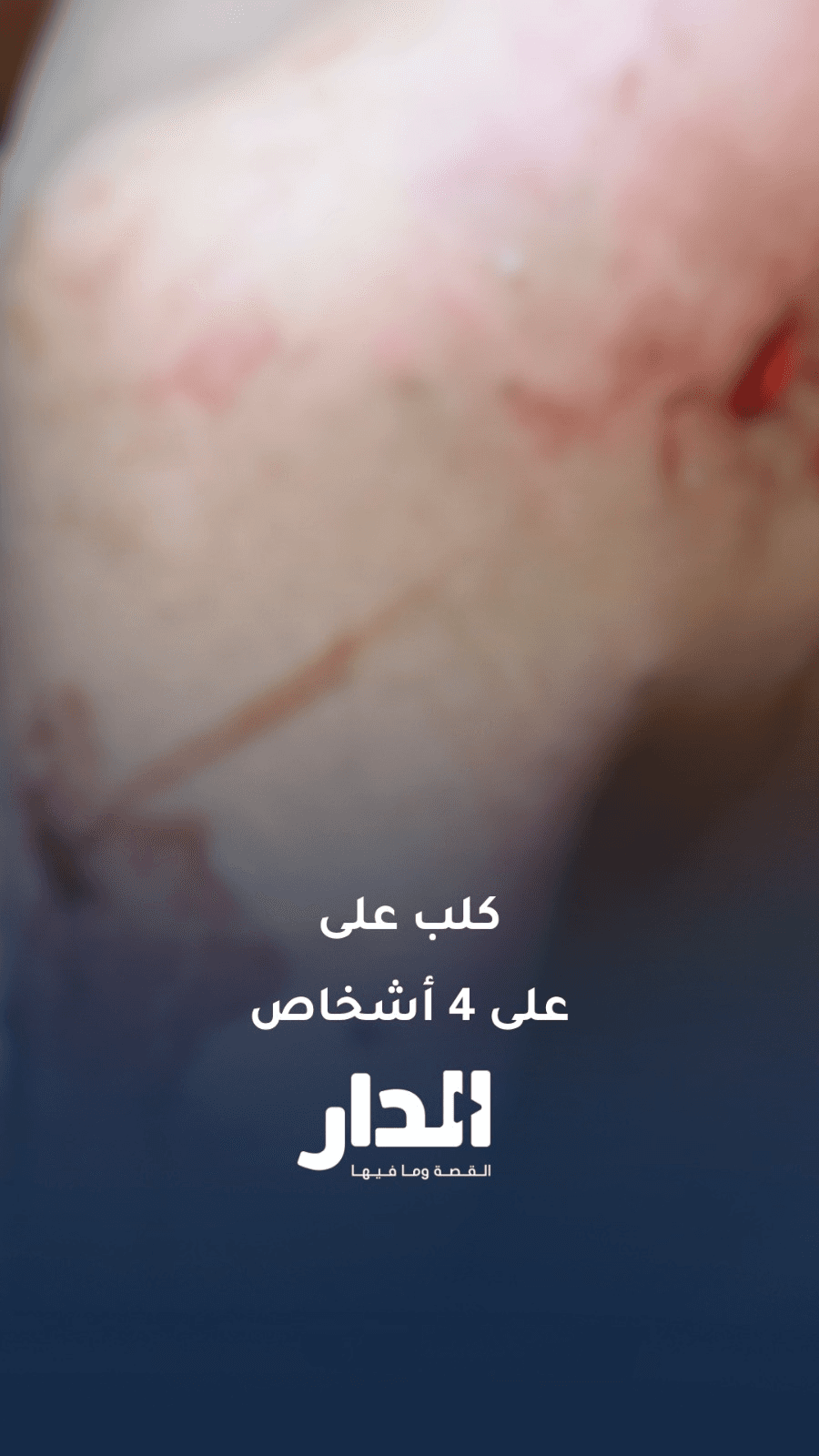 كلب يهاجم عددًا من الأشخاص بينهم طفلة ومسنة في زيزيا