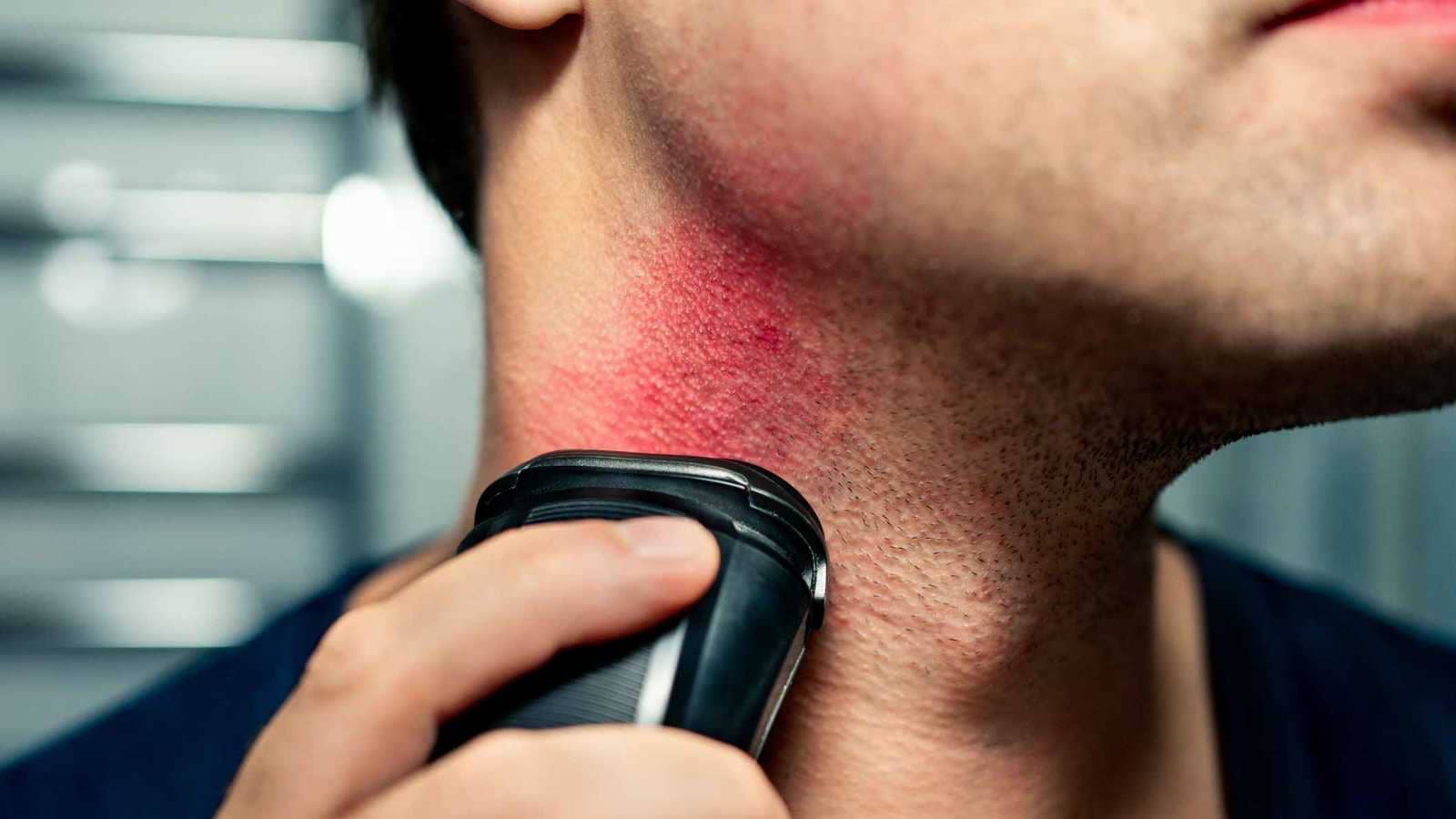 هل يمكن الوقاية من الشعر الناشب تحت الجلد؟.. الأطباء يوضحون