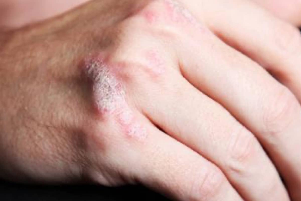 "الإكزيما الشتوية".. كيف تتجنب جفاف وتشقق اليدين مع اشتداد البرد؟