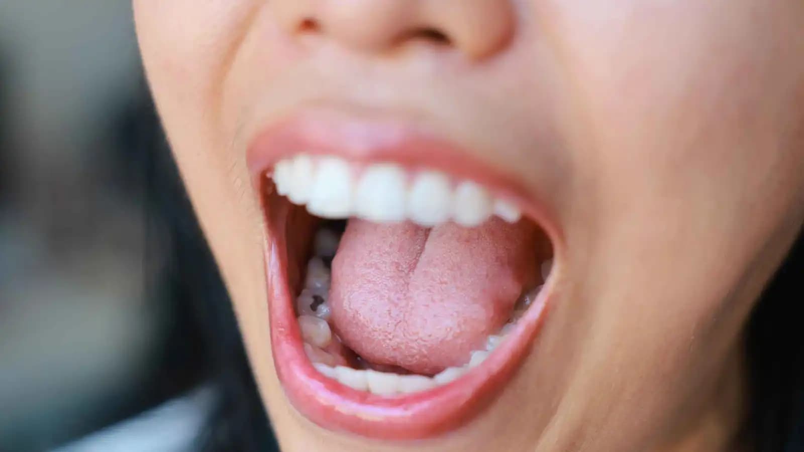 بكتيريا الفم تسهم في تصلب الشرايين والنوبات القلبية