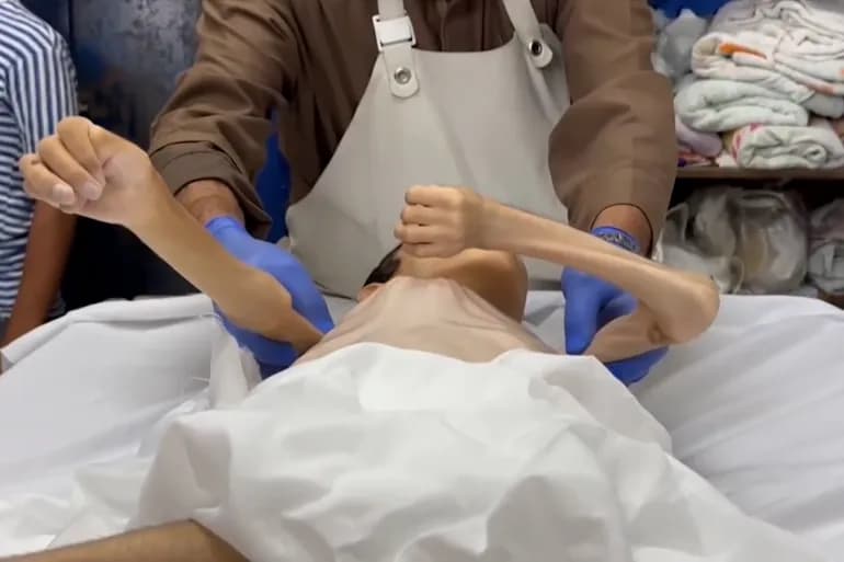 10 شهداء في غزة نتيجة المجاعة وسوء التغذية بينهم 3 أطفال خلال 24 ساعة