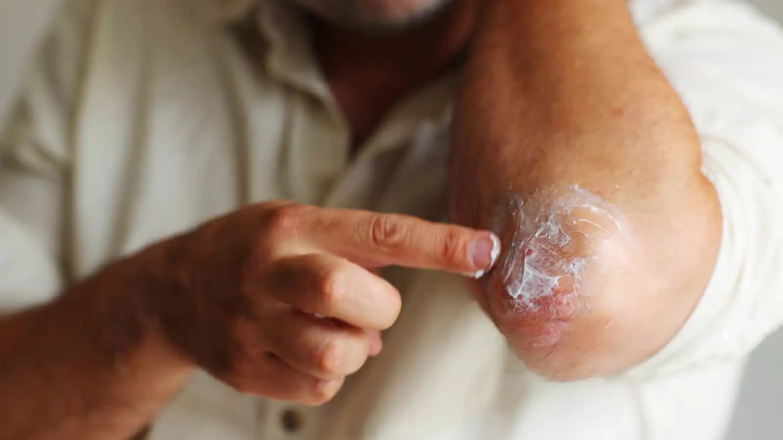 7 خطوات فعّالة لتخفيف نوبات " الإكزيما الشتوية"