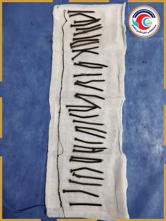 مصر.. فريق طبي ينقذ سيدة ابتلعت 34 مسمارا