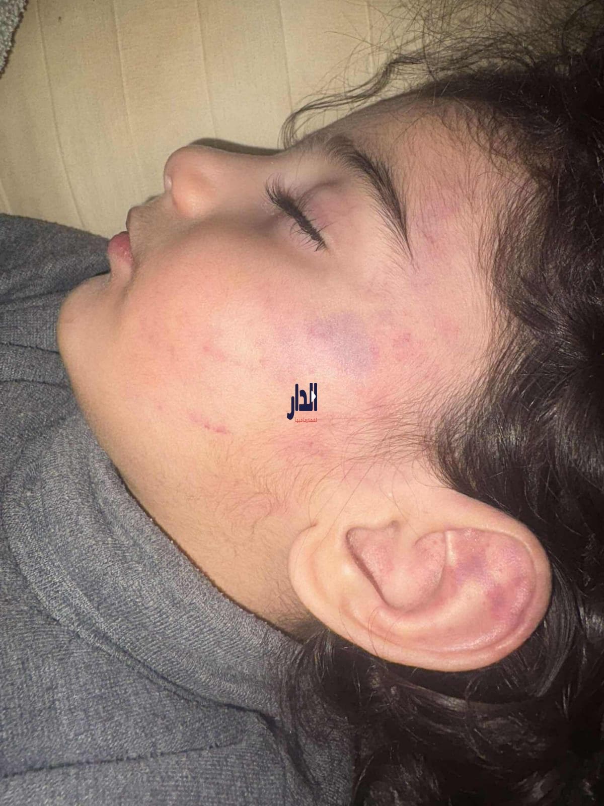 تعرض طفل "للتعذيب" على يد مالكة حضانة غير مرخصة في إربد - صور