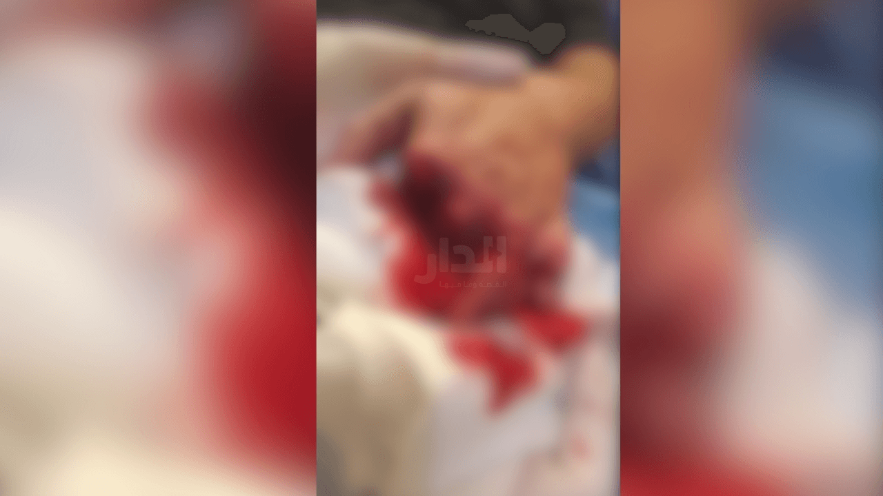 "أخذوا أصابعه ووضعوها في الثلاجة".. تفاصيل لـ "الدار" عن اعتداء أدى لبتر أصابع سائق تاكسي بماركا