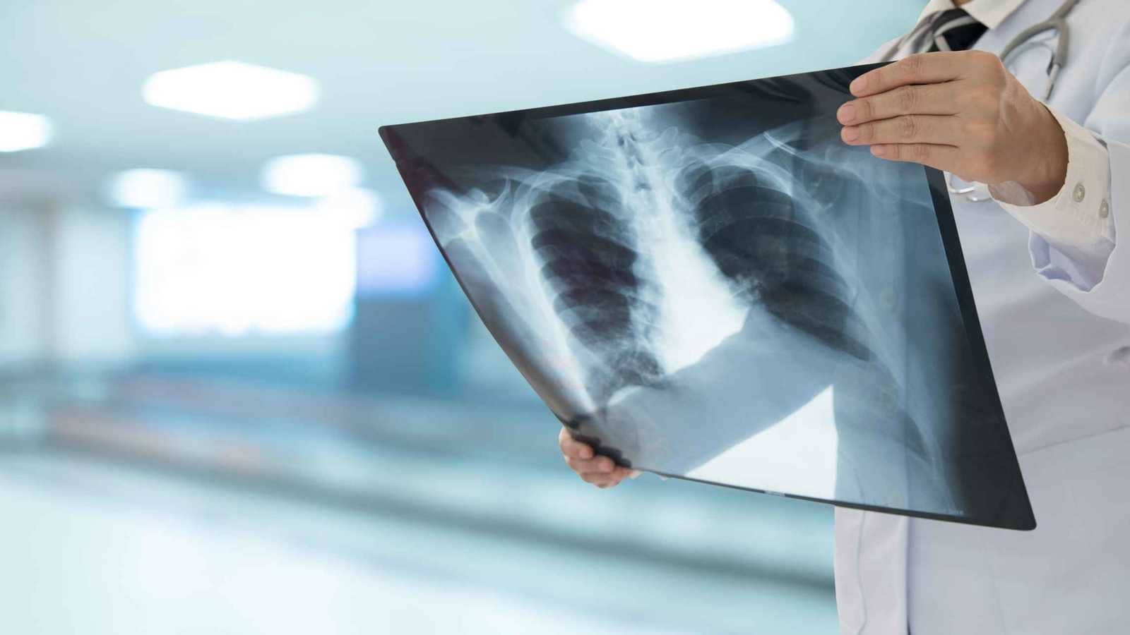 من الغذاء إلى الورم.. كيف يغذي السكر سرطان الرئة؟