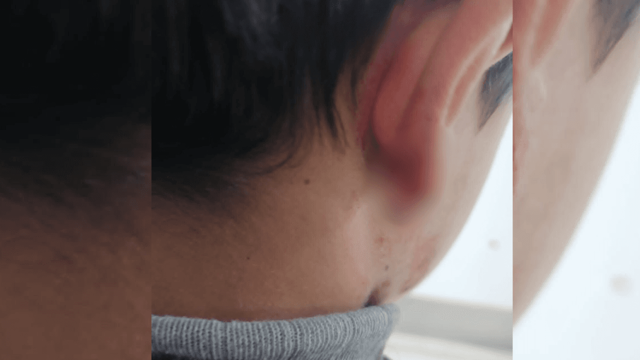 كلب ضال ينهش أذن طفل يبلغ 6 سنوات في إربد