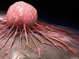 اعراض مخفية لسرطان الرئة يظهر على اليدين